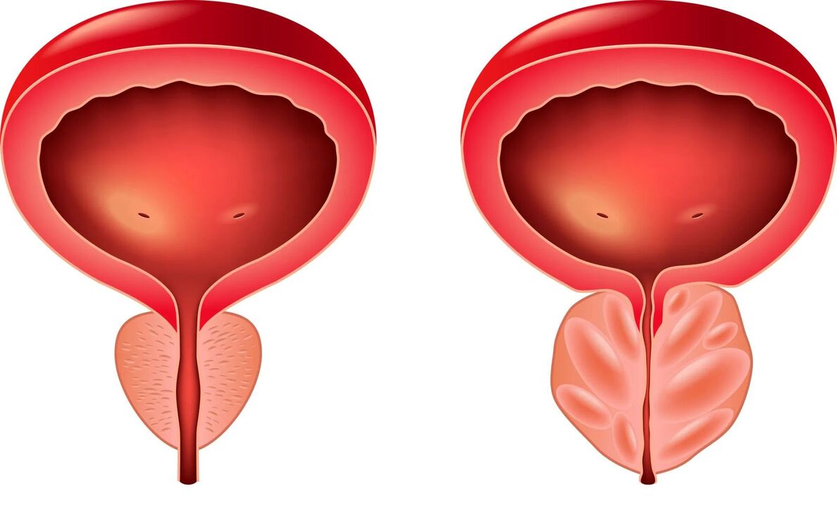 normal och sjuk prostata